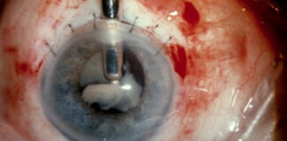 New Eye Drops Remarkably Dissolve Cataracts Without The Need For Surgery
