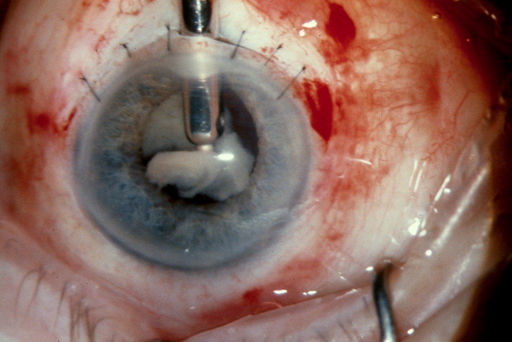 Traditional cataract surgery could be on its way out soon. 