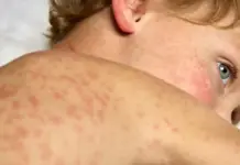 BREAKING STUDY: MMR and MMRV vaccines linked to 2,657% more U.S. deaths than measles infection since 1995