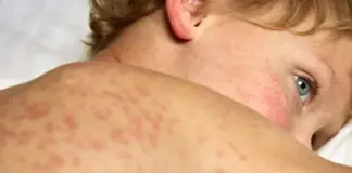 BREAKING STUDY: MMR and MMRV vaccines linked to 2,657% more U.S. deaths than measles infection since 1995