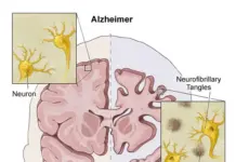 Dementia & Alzheimer’s Disease Cure Protocol