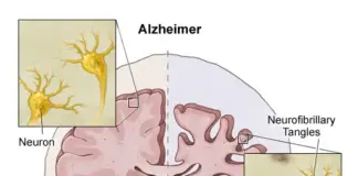 Dementia & Alzheimer’s Disease Cure Protocol